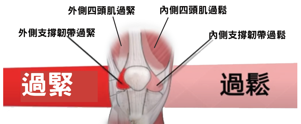 髕骨外移